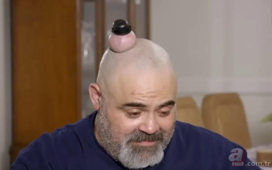 Sokağa şapka ile çıkıyordu! Başındaki şişlikten bakın ne çıktı 👩⚕️ Görenleri şaşkına çeviren olay 3