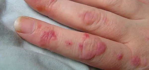 Lupus SLE hastalığı nedir? Lupus hastalığının belirtileri neler?