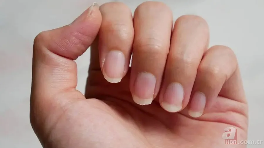 Tırnak diplerinizi kontrol edin! Belki de bu hastalıklardan birine sahipsiniz... 10
