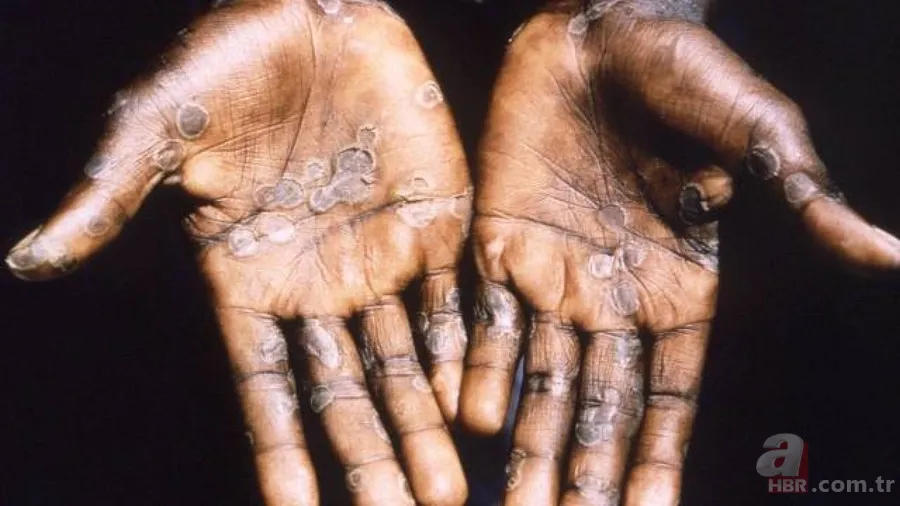 Maymun Çiçeği virüsü nedir, öldürür mü? Maymun Çiçeği hastalığının belirtileri neler, tedavisi var mı? Türkiye'de görüldü mü? 4