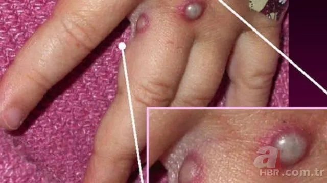 Maymun Çiçeği virüsü nedir, öldürür mü? Maymun Çiçeği hastalığının belirtileri neler, tedavisi var mı? Türkiye'de görüldü mü? 2