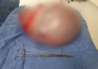 Giderek kilo almaya başladı soluğu doktorda aldı! Karnından çıkanı görünce gözlerine inanamadı 👨⚕️ Ameliyat sonrası 9 kilo zayıfladı