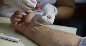 Çocuklarda besin alerjilerine dikkat!