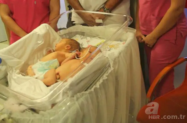 Yapışık ikizler dünyaya geldi 6
