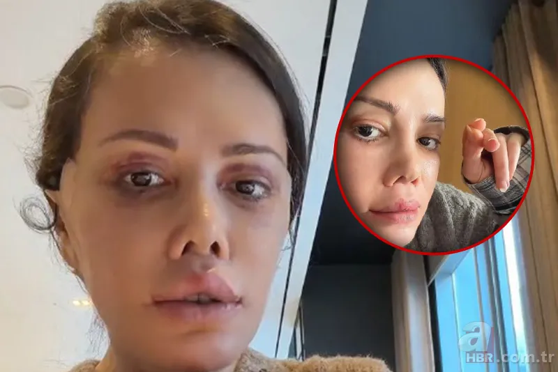 Yüz nakli sonrası ilginç gelişme! Didem Ceran'ın kaşında saç çıktı 1
