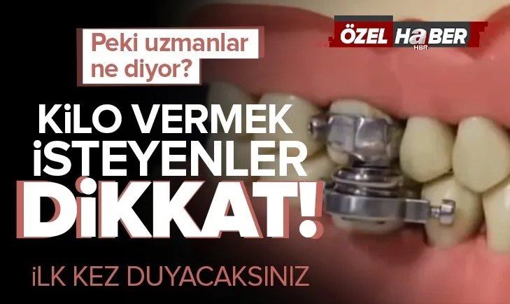 Obeziteye karşı yeni icat: Çene kilidi