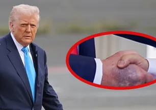 Görüntüsü gündem olmuştu! Trump'ın elindeki morlukların nedeni belli oldu