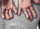 Maymun çiçeği hastalığında ilk ölüm!