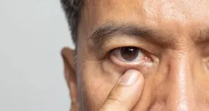 Gözlerdeki bu değişim yüksek kolesterolün habercisi olabilir!