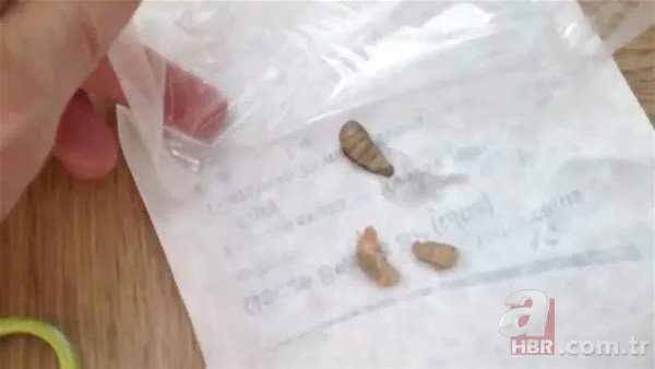 Genç kadının kolundan çıkanlar şoke etti 22