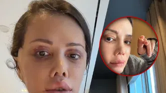 Yüz nakli sonrası ilginç gelişme! Didem Ceran'ın kaşında saç çıktı