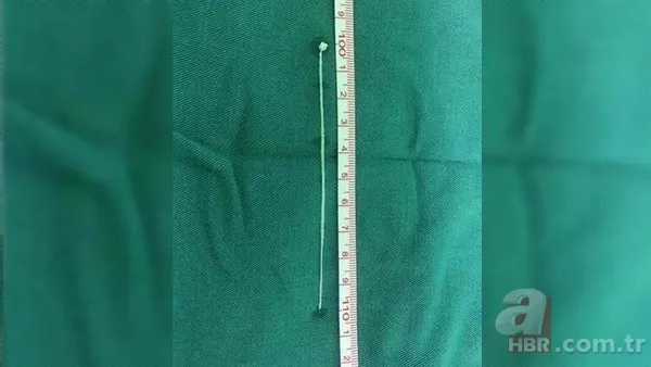 30 yıl boyunca baş ağrısıyla yaşadı! Nedeni şoke etti... 3