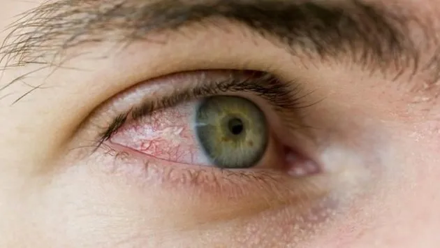 Göz alerjisi neden olur? Belirtileri ve tedavi yöntemi...