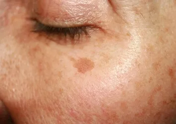 Güneşe uzun süre maruz kalmak cilt lekelerine neden oluyor!