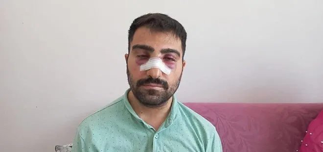 Amasya’da akılalmaz olay! Engelli komşusunun burnunu kırdı: Yetmedi ardından sıcak su döktü