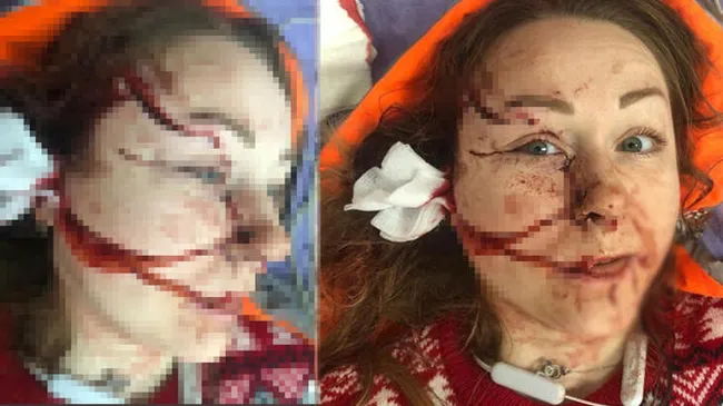 Boşanmak istediği için kocasının yüzünü falçatayla parçalandığı Ukraynalı Hanna yeni bir hayat kurdu - 6