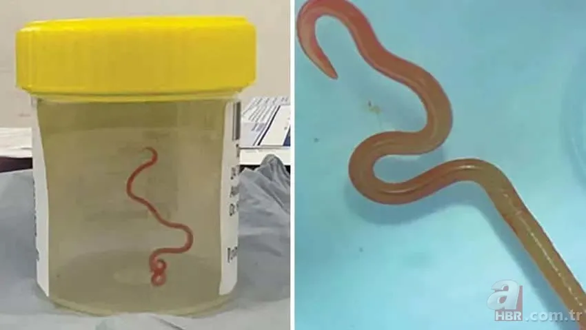 İnanılmaz olay! Dünyada bir ilk: Beyninden çıkan şey herkesi şoke etti 4