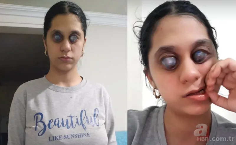 Sosyal medyada fotoğrafını görenler photoshop sanıyor! Genç Ümran’ın gözleri doğuştan… 6