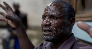 Afrika Birliği’nden M çiçeği salgını açıklaması!