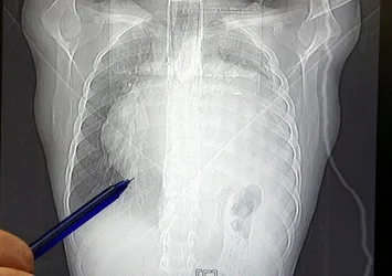 Röntgeni görünce doktorlar bile şaşkına döndü! Kalbi 12 santim kaydı, içinden kilolarca...