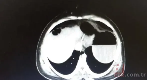 Doktorlar bile hamile sandı! Çıkanlara kimse inanamadı... 6