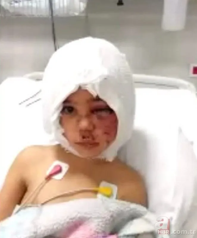 Pitbull saldırısına uğrayan Asiye’nin ameliyatı başladı! Antalya’da kritik ameliyat