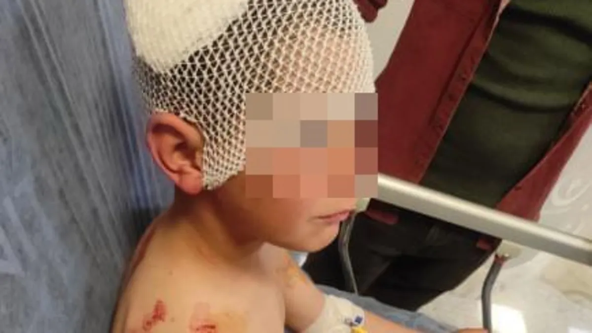 Sokak köpekleri dehşet saçtı: 9 yaşındaki çocuğu kafasından ısırdı