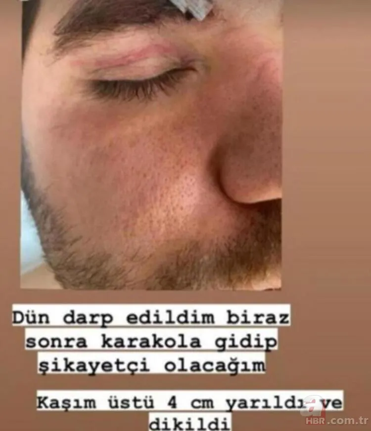 Ceyhun Fersoy ve Begüm Öner mekanda saldırıya uğradı! Darp görüntüleri ortaya çıktı 5