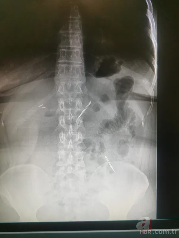 Amasya’da 22 yaşındaki genç kız karın ağrısı şikayetiyle hastaneye gitti! Gerçek şoke etti: Tam 5 kilo 15