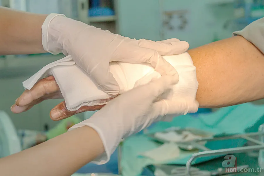 Küçük ama riskli! Kıymık çıkarırken dikkat etmeniz gerekenler 3