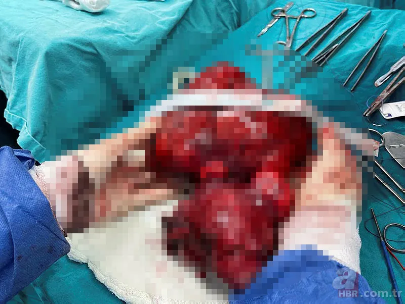 Amasya’da 22 yaşındaki genç kız karın ağrısı şikayetiyle hastaneye gitti! Gerçek şoke etti: Tam 5 kilo 9
