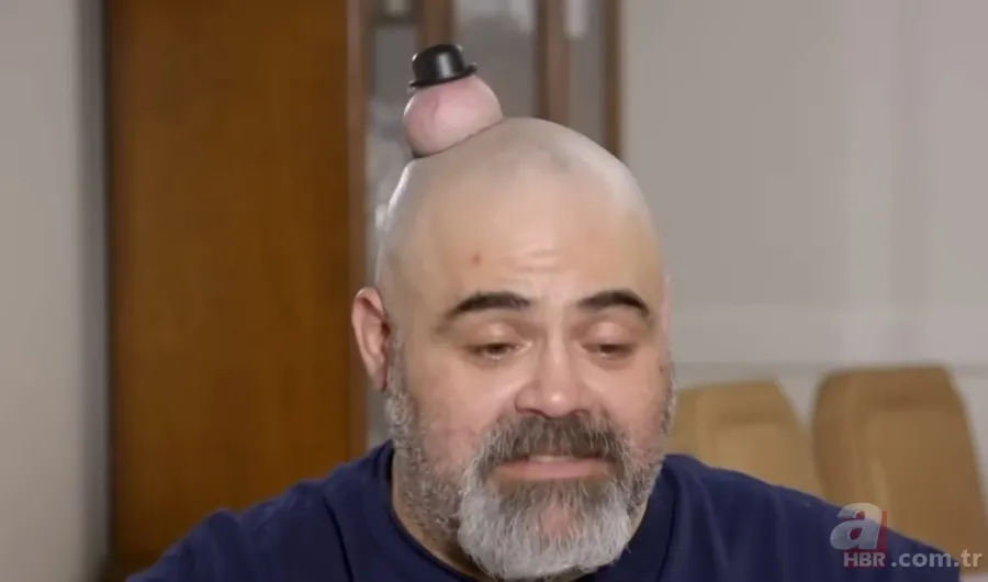 Sokağa şapka ile çıkıyordu! Başındaki şişlikten bakın ne çıktı 👩⚕️ Görenleri şaşkına çeviren olay 2