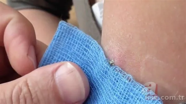 Kolundaki sivilceden böcek çıktı 👩⚕️ Doktora gidince şoke oldu | Cımbızla çektikçe içi gitti 2