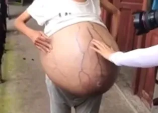 Son dakika: Tıp dünyası şokta! Aniden karnı şişti! Genç kadındaki 20 kiloluk kütlenin gizemi çözülemiyor