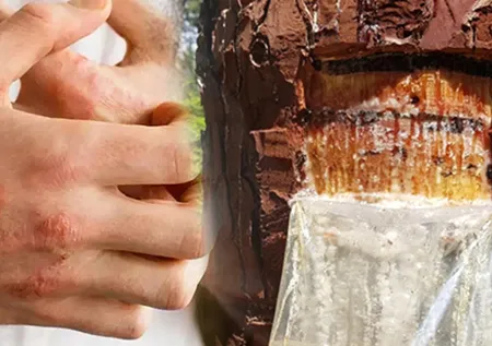 Egzamanın kökünü kurutan doğal ilaç tarifi! 