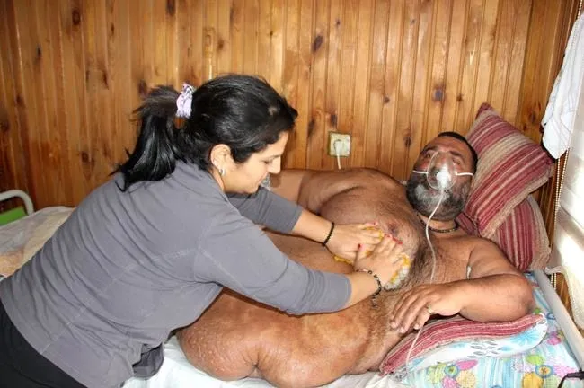 300 kilo ağırlığında ve yüzde 92 engelli adam yataktan kalkamıyor - 1