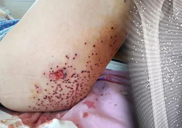 Genç kadın vücudunda 600 saçmayla yaşıyor!