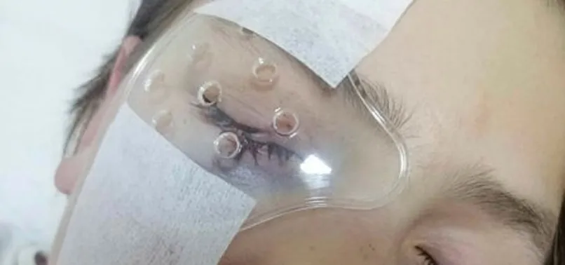 Aydın'da babasıyla yastık savaşı yapan Belinay'ın gözüne avizedeki çam parçaları isabet etti