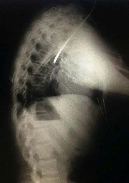 Dişini karıştırdığı çatal boğazına takıldı - 1