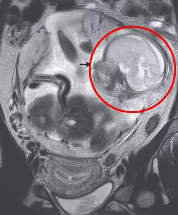 bagirsakta-buyuyen-bebek-olayi-soke-etti-doktorlar-gordukleri-karsisinda-dondu-meger-55-aylik-1702450654483.jpg Bağırsakta büyüyen bebek olayı şoke etti! Doktorlar gördükleri karşısında dondu! Meğer 5,5 aylık... - 1