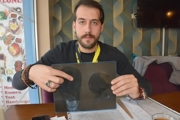 Ağzında çıkması gereken diş, beyninde çıktı - 1
