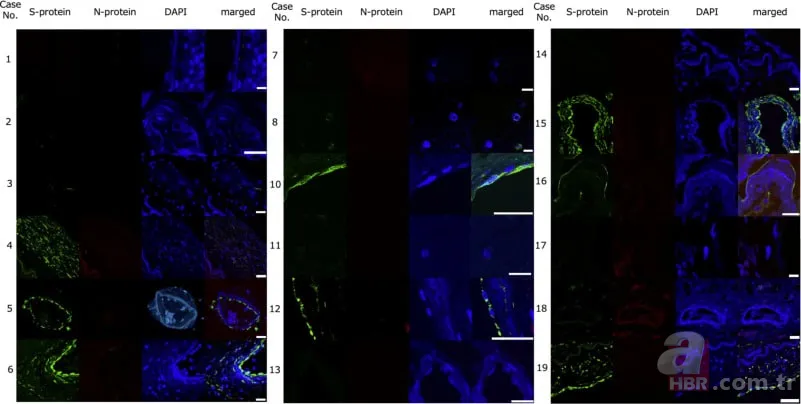 Felç riski COVID-19 aşısıyla artıyor mu? 100 binden fazla kişide görüldü: 17 ay hücrelerde birikerek... 6