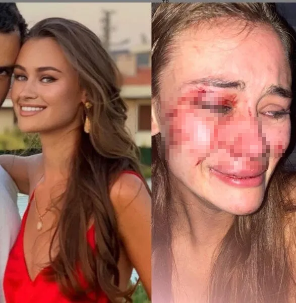 Daria Kyryliuk’u sevgilisi mi dövdü? Sürpriz tanıktan Ukraynalı model ile ilgili yeni iddia