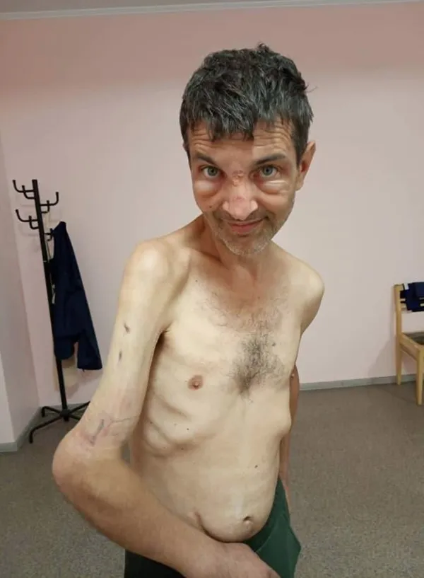 Esir düşen Ukraynalı askerin değişimi: Önceki halini görenler inanamadı