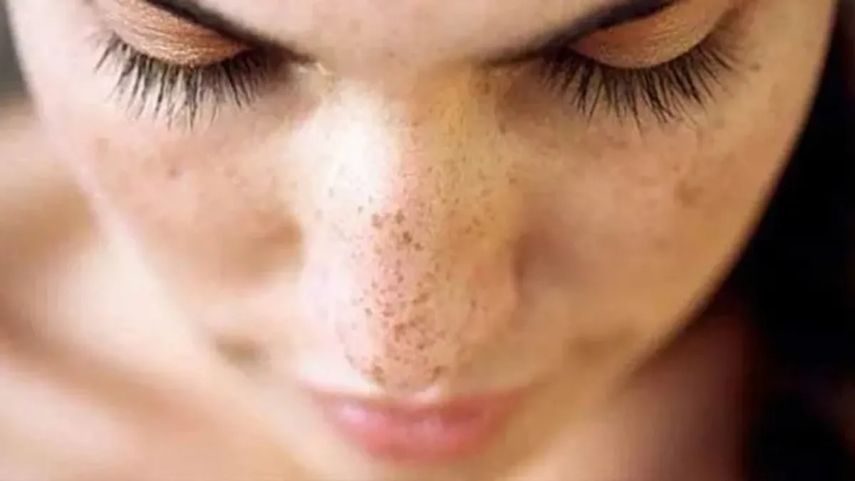 Güneş lekeleri nasıl oluşur? Uzmanı açıkladı...