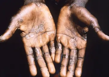 DSÖ'den çarpıcı 'M çiçeği virüsü' açıklaması: Durdurulabilir |  İlk belirtiler ne zaman ortaya çıkıyor?