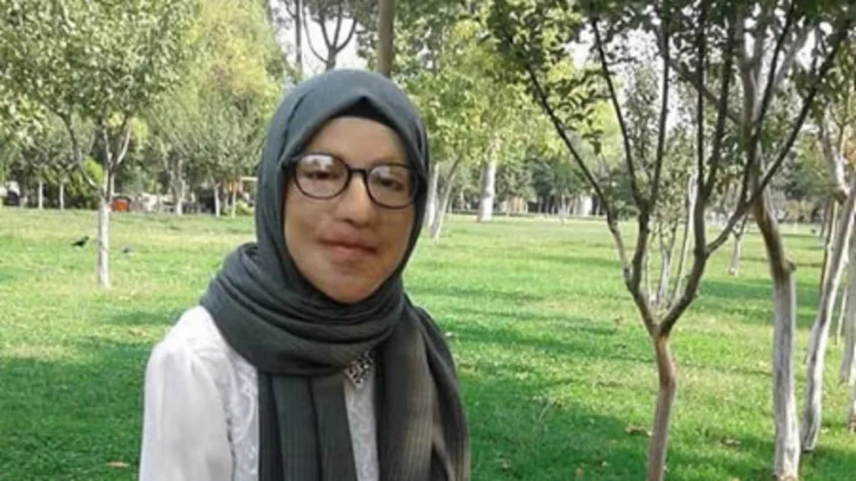 Yeni bir yüz yeni bir hayat! 2 yaşından beri 47 kez ameliyat oldu