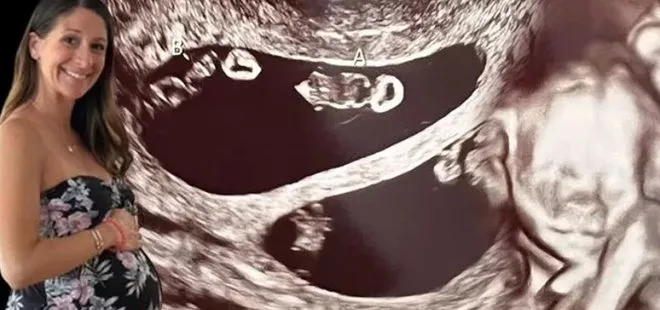 ABD’de şoke eden olay! Ultrasonda ortaya çıktı 70 milyonda bir görülüyor