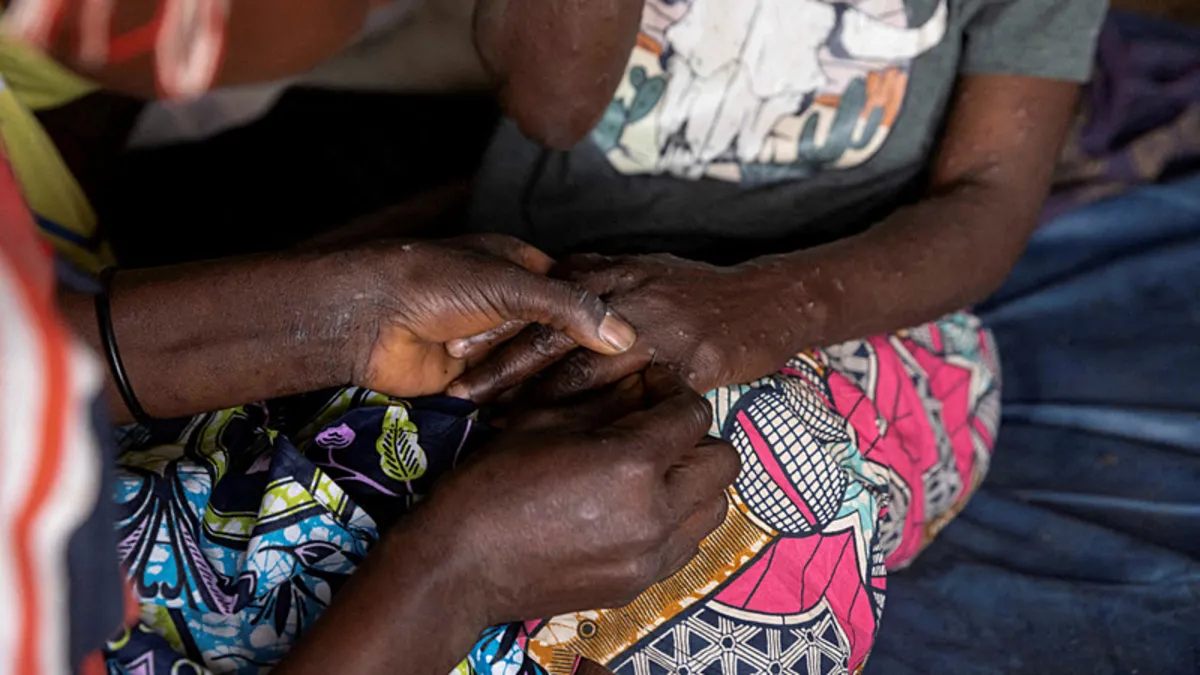 Gana'da M çiçeği vaka sayısı 494'e yükseldi