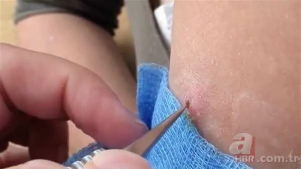 Genç kadının kolundan çıkanlar şoke etti 3